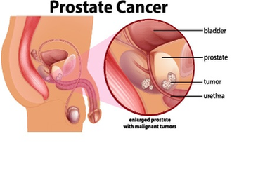 Sexual Intercourse, Not Masturbation Could Help Prevent Prostate Cancer – Expert image